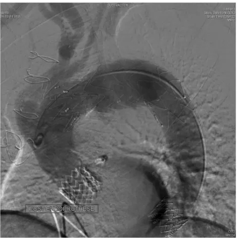 Figure 2. Angiography at the end of the procedure. The proximal Sapien prosthesis is in anatomical position without residual aortic regurgitation or paravalvular leak