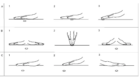 Figure 1. Schematic of the Ou MC handing remedy (HR) technique. The HR was performed by placing the contralateral hand on the affected area (A1-A3)