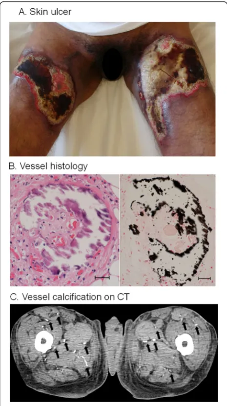 Fig. 1 Findings in a patient with severe skin ulcers secondary tocalciphylaxis. a Calciphylaxis-induced skin ulcers on admission.b Histology of biopsy specimen from the ulcer on the left thighstained with hematoxylin and eosin stain (B1) and von Kossa stai