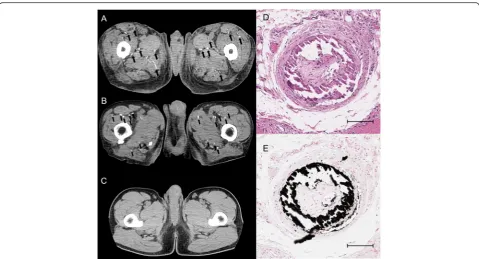 Fig. 2 Findings of calcification on computed tomography (CT).chronic hemodialysis patient.an autopsy case