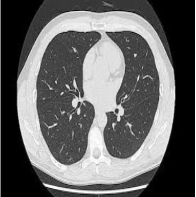 Figure 2a: Normal Lung iamge  