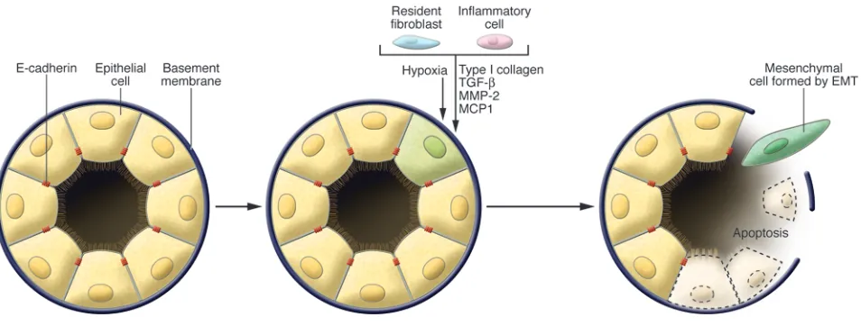 Figure 3EMT and fibrosis. The EMTs associated with fibrosis are associated with inflammation and the generation of numerous types of molecules by 