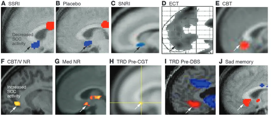 Figure 3Converging evidence implicating the SCC region in MDD. (