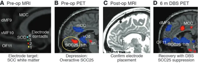 Figure 4Selective targeting of the depression circuit with DBS in patients with TRD. (