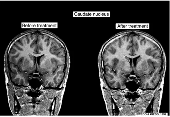 Figure 3Serial T1-weighted brain MRIs of a 14-year-old male 
