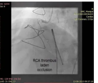 Figure 1. Sinus nodal artery and RCA with 70% stenosis—2006 angiogram.          