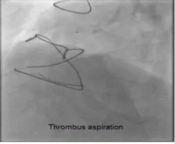 Figure 3. SVG to RCA angiogram.           