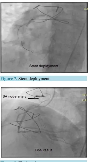 Figure 7. Stent deployment.                     