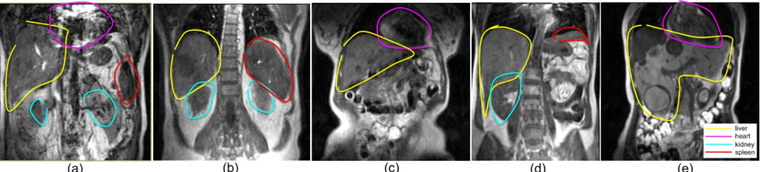 Fig. 1: The shapes of the organs vary substantially, and the shape of liver with metastases can be very abnormal (e)