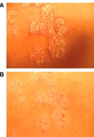 Figure 4Improvement of psoriasis during treatment with AEB071 in a represen-
