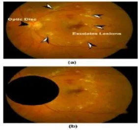 FIG 7: (A) Color Retinal Image (B) ROI Exudate.