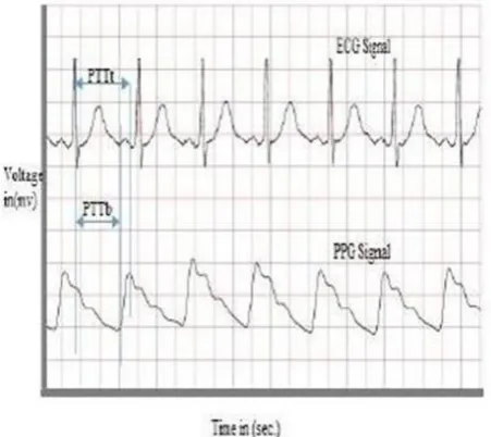 Fig. 5. Acquisition of PTT using ECG and PPG (Source: Sarveshkumar et al, 2015) 