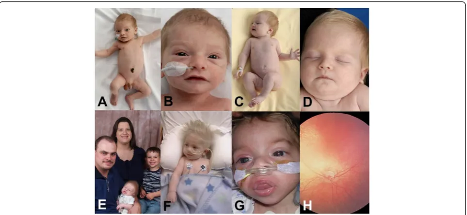 Fig. 1 Clinical features of Vici syndrome. Note hypopigmentation in relation to ethnic (a–d, of Turkish origin) and familial (e–f) background