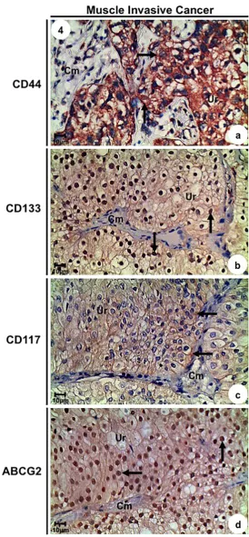 Figure 4. Immunolabelled of the urinary bladder from Muscle Invasive group. (a) CD44 immunoreactivity (arrows) in the urothelium; (b) CD133 immunoreactivity (arrows) in the urothelium; (c) CD117 immunoreac-tivity (arrows) in the urothelium; (d) ABCG2 immun