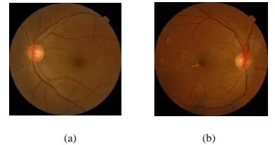 Fig 1 Fundus image (a) Normal Fundus image (b) Fundus image with DR [5] 