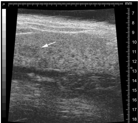 Figure 1 The representative image of ultrasound detected the tumor growth in liver.Notes: arrow indicates the tumor; length, 2.2 mm; width, 1.5 mm.