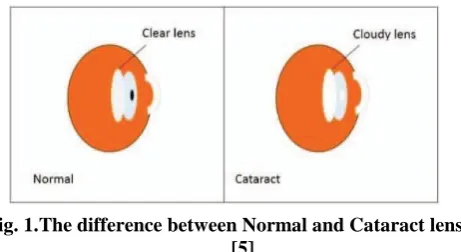 Fig. 1.  The difference between Normal and Cataract lens [5] 