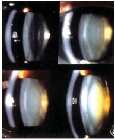 Fig. 2. Grade levels in Cataract [7] 