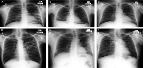 Fig .2:  CXR and its lung model  