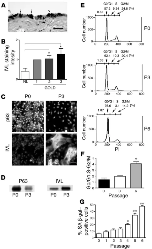 Figure 1SM correlates with increased GOLD stage of COPD in human lung 