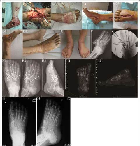Fig. 1 Male patient, aged 55, with right foot severe open Lisfranc fracture-dislocation, was admitted to hospital 2 h after being crushed under heavy objects.