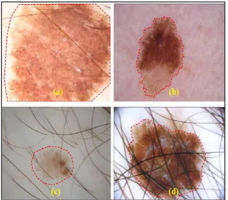 Fig. 2: Dermoscopic images with automated lesion  segmentation. (a) bulky size of lesion; (b) uneven and blurry border; (c) lower contrast with respect to the surrounding skin; and (d) lesion with hair