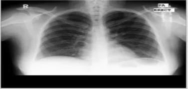Fig - 2: Chest x-ray test image 