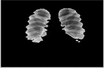 Fig 4 shows normal chest X- ray and fig 5 shows its classification result.10 normal and 12 abnormal chest x- ray images are used to train the classifiers 