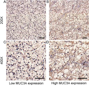 Figure 1: MUC3A expression in localized clear-cell renal cell carcinoma (ccRCC) tissues