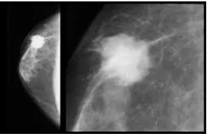 Fig (3)  malignant case 