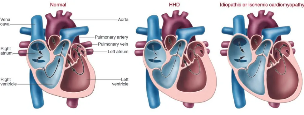 Figure 1Schematic representation of changes in the cardiac chambers of an individual with HHD compared with idiopathic or ischemic cardiomyopathy