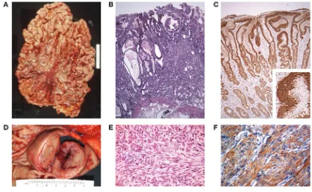 Figure 2Gross and microscopic view of Ménétrier disease and GIST. (A and B) Gross (A) and microscopic (B) appearance of the stomach of a patient with 