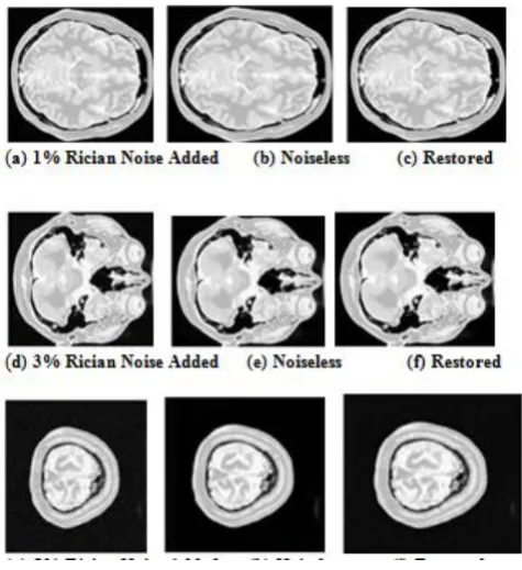 Table : 3 Performance Measures for existing and proposed model for Pd-weighted image of Axial View Test Noise MSE  RMSE  PSNR  SSIM  