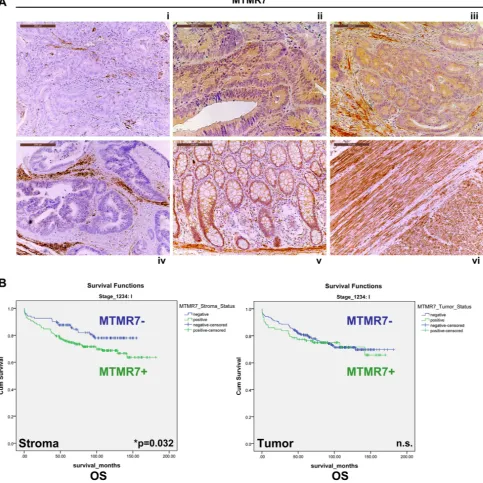 Figure 3: Expression and prognostic significance of MTMR7 in CRC patients. A. Immunohistochemistry (IHC) with MTMR7 Ab (from Abcam) on tissue microarrays (TMAs) with tumor (n=1776) specimens from CRC patients