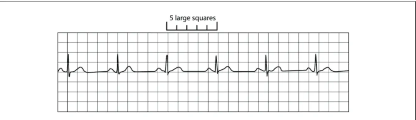 Figure 3 Work out the heart rate from this ECG trace, see question 2. 
