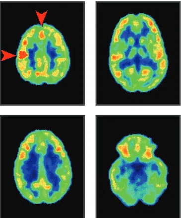 Figure 4 Image of the brain of a person who is performing a motor task, namely hopping up and down on one leg
