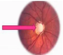 Figure 2. Superpixel based optic disc segmentation
