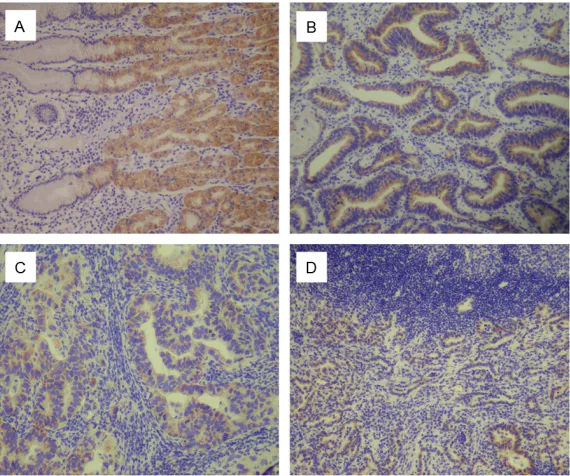 Figure 1. Immunohistochemical staining for FAT2 in gastric cancer lesions and noncancerous tissues