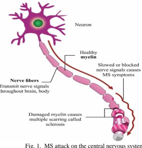 Fig. 1.  MS attack on the central nervous system   (Source: neurologicalwellness.com) 