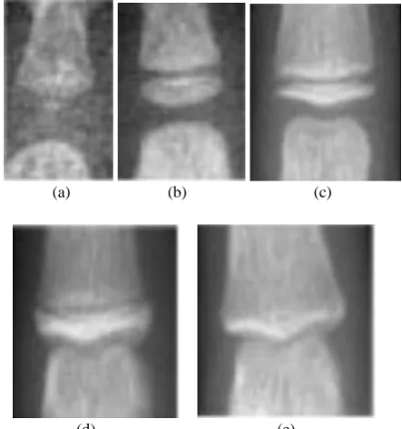 Fig 2 (c), band among the shaft and ossification center eliminate in fig 2(d) unless that removes, in fig 2(e), epiphysis and metaphysis penetrate in adult skeleton bone