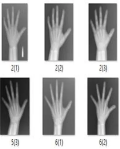 Fig. 4: Hand Wrist X-Ray Images 