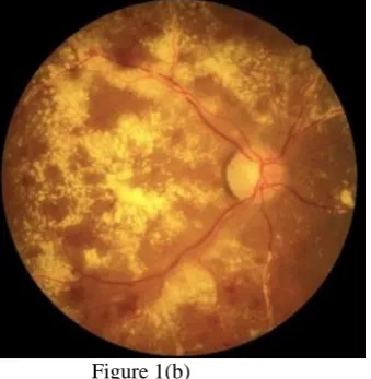 Figure 1(b) Figure 1b. Fundus image of Retina affected with exudates 