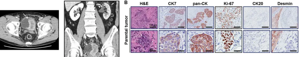 Figure 1: Case presentation of patient 138T with muscle-invasive bladder cancer and validation of patient-derived tumor tissue