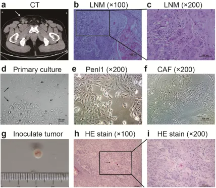 Figure 1: Morphology of LNM, Penl1 cells and their inoculated tumors in SCID mice. a. Computed tomography (CT) of the patient revealed a 17-mm enlarged lymph node in the right groin area, which was considered to be metastasis