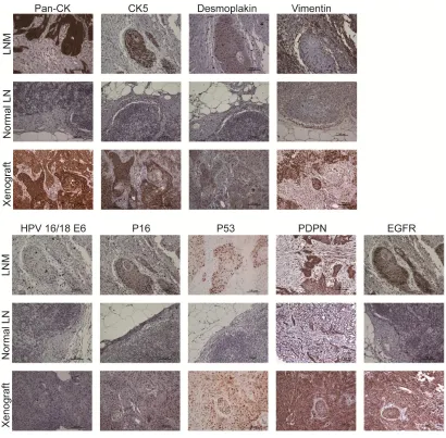 Figure 3: Immunophenotype of indicated cellular biomarkers and HPV subtype markers among LNM, normal lymph nodes and xenografted tumors