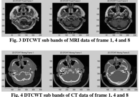 Fig. 3 DTCWT sub bands of MRI data of frame 1, 4 and 8 