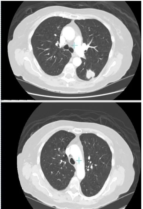 Fig.18 Lung Normal and Cancerous  Image Comparision   