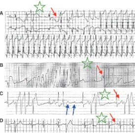 Figure 1Examples of acquired long QT syndrome. A common fea-