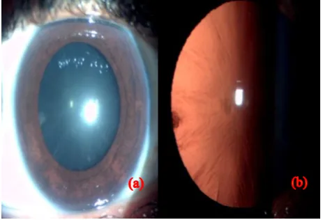 Table 3: Best corrected visual acuity (BCVA) converted to logarithm of minimal angle of resolution (logMAR) in patients who developed cataract with various antidepressants