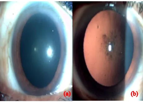 Figure 4 (a, b): Posterior sub-capsular cataract on diffuse illumination and retro-illumination